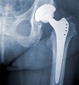High Performance Ceramic with Uniform Nanostructure Designed for Increased Life-span of Orthopaedic Implants