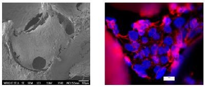 Bone cells cultured on foam: (a) Electron Microscope images showing cells grow well on carbon foam (b) Cell staining images showing details of the nuclei (blue) and Cytoplasm (pink).
