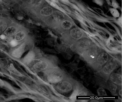 The microphotograph shows a particular of a liver sample affected by cancer. Inside a cell, in the nucleus, a submichronic particle of Titanium is present.