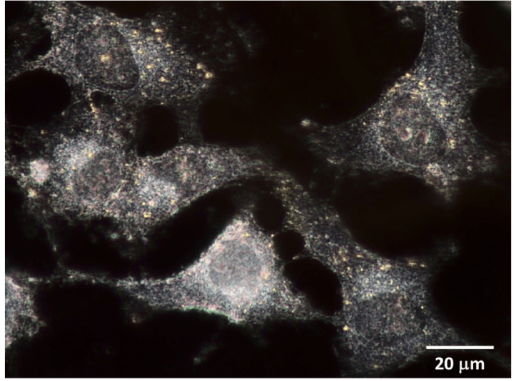 Dark field image of human breast cancer cells tagged with gold nano particles (60 nm size).