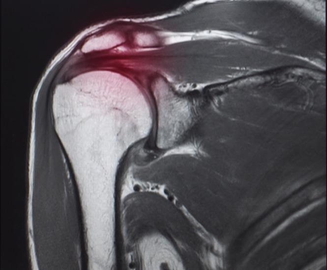 tendon bone healing, nanoparticles