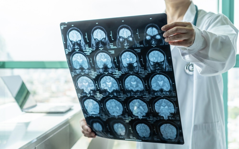 Brain disease diagnosis with medical doctor seeing Magnetic Resonance Imaging (MRI) film diagnosing elderly ageing patient neurodegenerative illness problem for neurological medical treatment