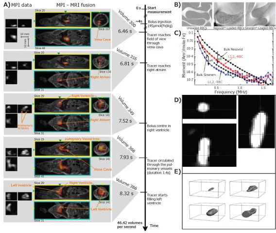 A) Dynamic images of MPI (left) and MPI-MRI fusion (right) of a beating mouse heart; B) TEM images of control and NP-labeled red blood cells and C) MPI signal data for Resovist®, Sinerem®, Resovist®-labeled and Sinerem®-loaded red blood cells (L1,2R-RBC and L1,2S-RBC, respectively); D) the MPI axial, coronal, and sagittal-view of balloon catheter filled with IONPs (Resovist®), and E) 3D rendering images of balloon being deflated (top left), during inflation (top right), inflated (bottom left), and being moved out of the field of view (bottom right).