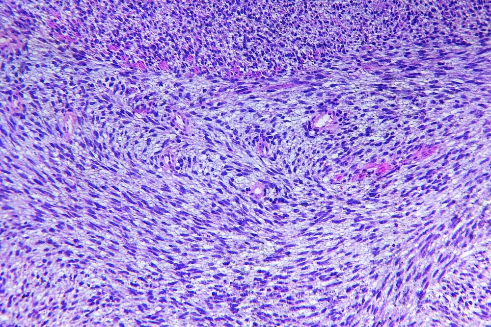 Fibrosarcoma of a human, photomicrograph panorama as seen under the microscope, 200x zoom.