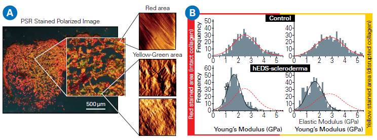 A: Correlated AFM and polarized light microscopy images (Picosirius Red-stained) reveal intact collagen regions (red) and compromised areas (yellow/green) in skin samples from control and hEDS-scleroderma patients. B: Distributions of collagen fibril Young’s modulus for healthy and disrupted regions. In the control specimen, both region types exhibit a unimodal stiffness distribution. In hEDSscleroderma samples, the modulus values are significantly lower, consistent with reduced collagen stiffness. The red dotted line represents the collagen stiffness distribution of the control group. Data courtesy of Laurent Bozec, University of Toronto, Canada.
