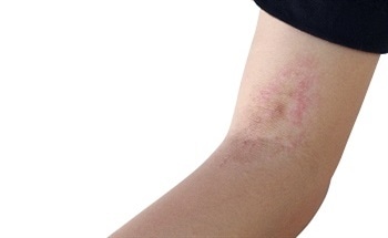 Nitric-Oxide-Releasing Nanoparticles for Skin Infection Treatment
