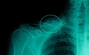 Magnetic Nanoparticles to Assist in Bone Tissue Engineering