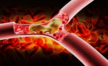 Plaques Causing Heart Attacks – Can Nanoparticles Help?