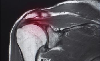 Using Nanoparticles to Promote Tendon–Bone Healing