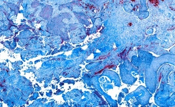 Applying Gold Nanomaterials to Oral Cancer Theranostics