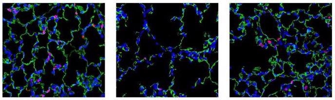 Nanoparticle-Based Therapy Could Treat Fatal Lung Disease in Newborns.