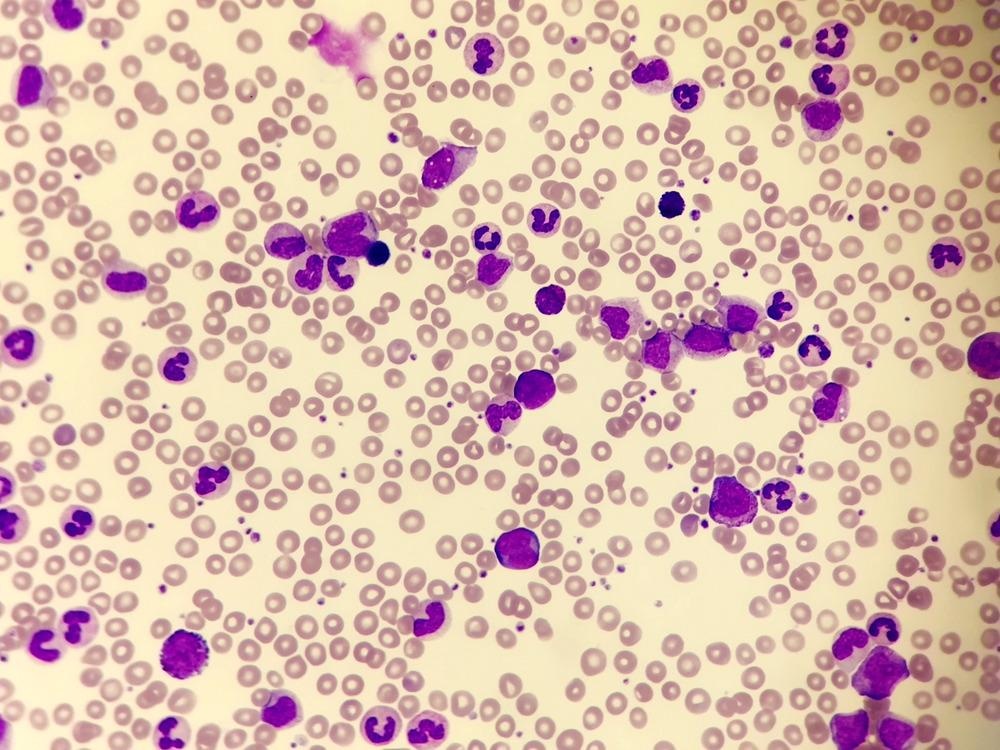 MXene Analytical Tool to Diagnose Chronic Myeloid Leukemia