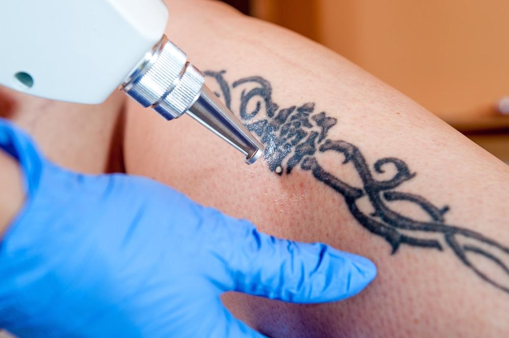 Scientists Report the Ideal Laser to Enhance Tattoo Removal
