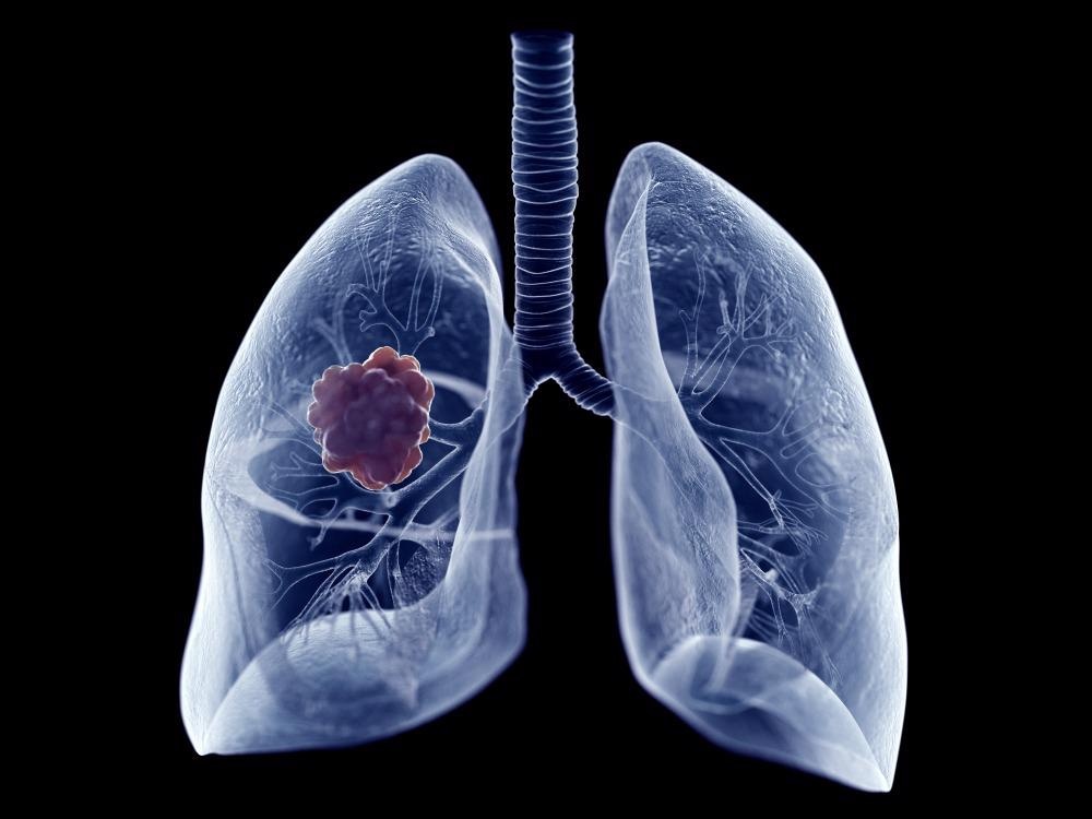 Nanoplatform Integrates Effectively with Cancer Therapies