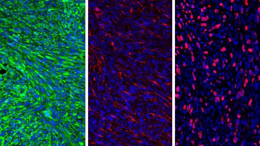 Nanoparticles Effectively Used to Delay or Prevent Relapse of Brain Cancer in Mice Models