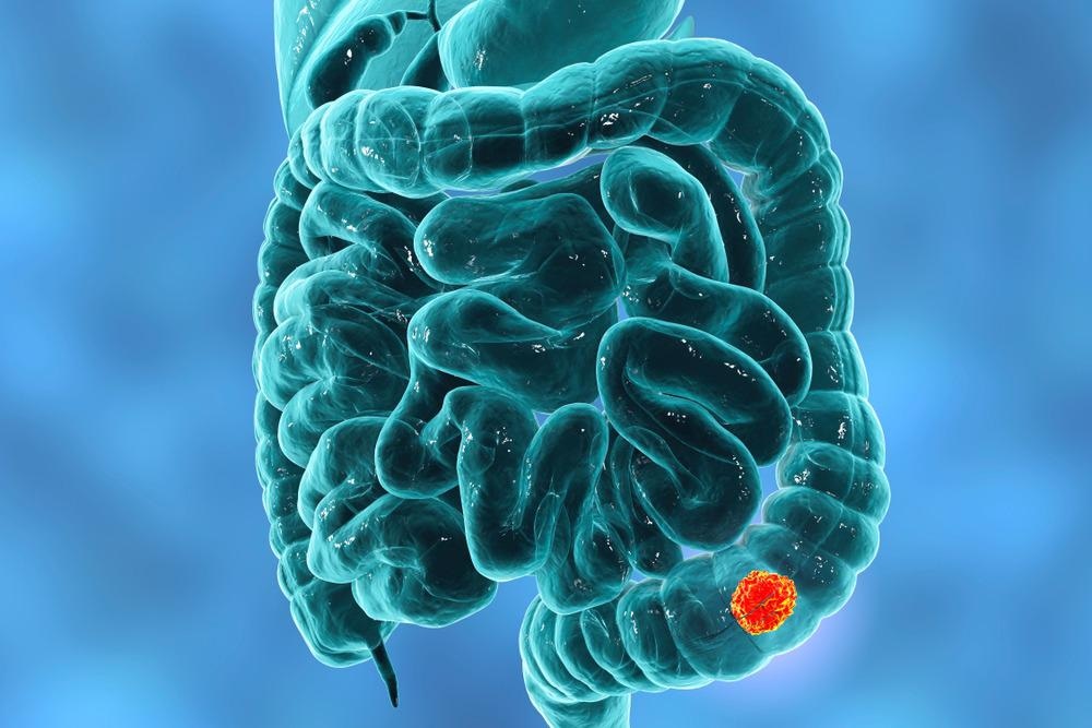 Colorectal Cancer Drug Delivery System Combines Nanoparticles and Hyaluronic Acid