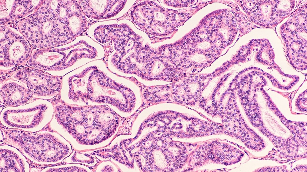 These Nanoparticles are Promising Candidates for Sustained Breast Cancer Drug Delivery