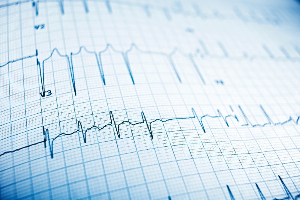 New Technique to Construct Dry Electrodes for ECG Monitoring