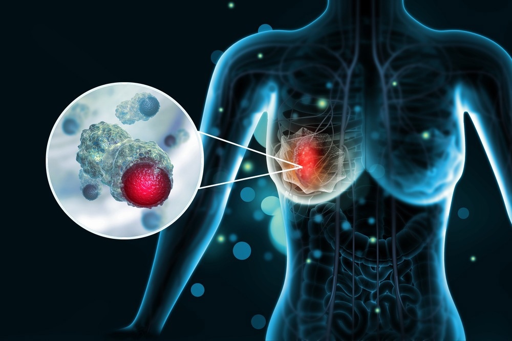 Nanomedicine Specifically Targets Triple-Negative Breast Cancer