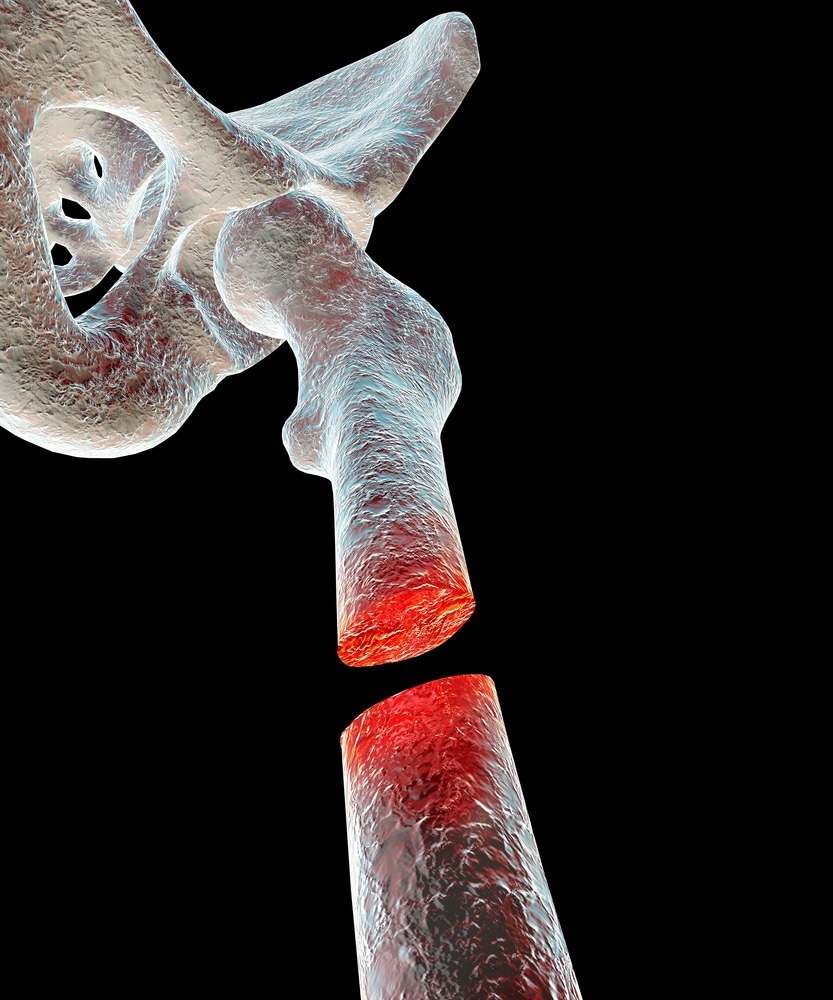 Microgel Encourages Bone Regeneration in Critical-Size Defects