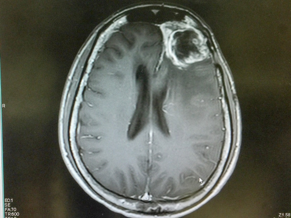 Glioblastoma Targeting Cell Membrane Nanovesicles