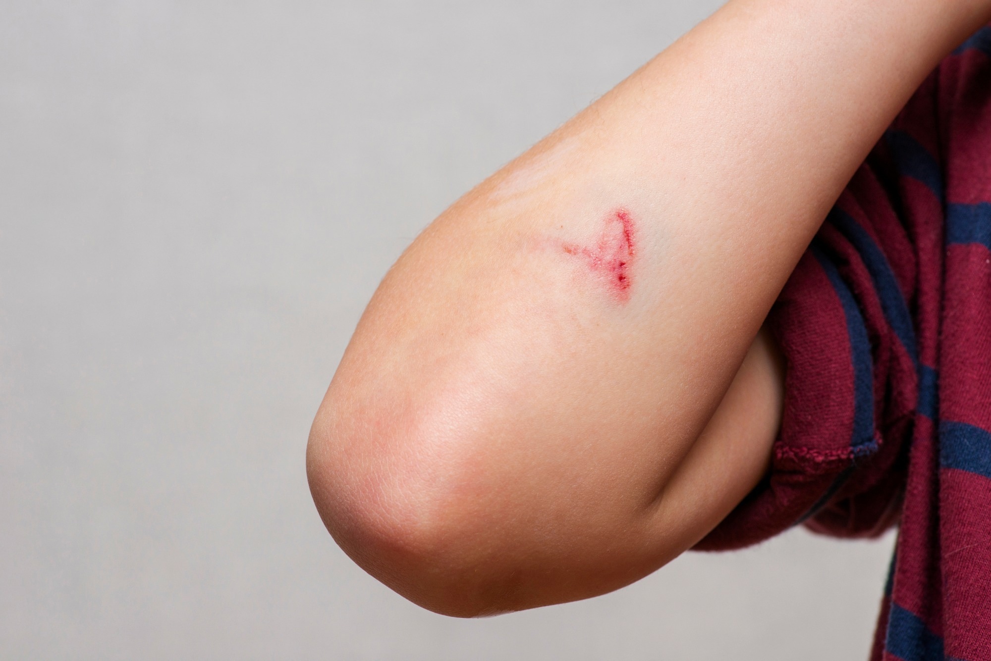 TRGO/ZnO Nanocomposites: A Promising Antibacterial Solution for Wound Healing
