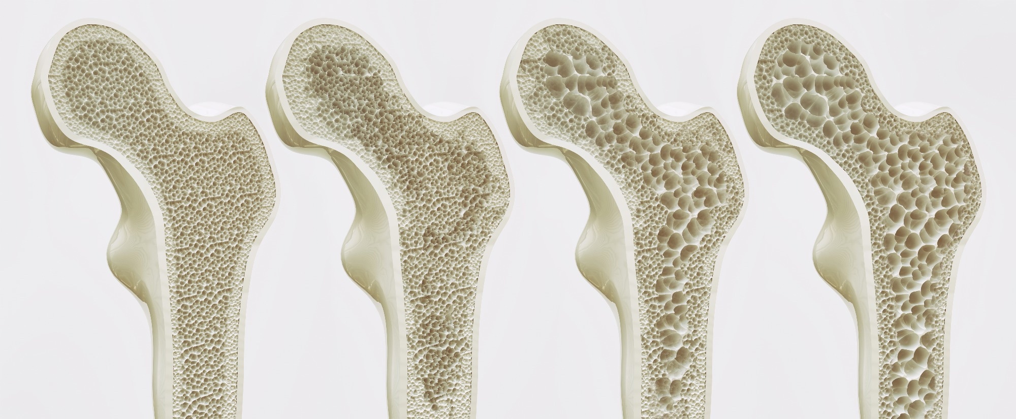 The four stages of osteoporosis.