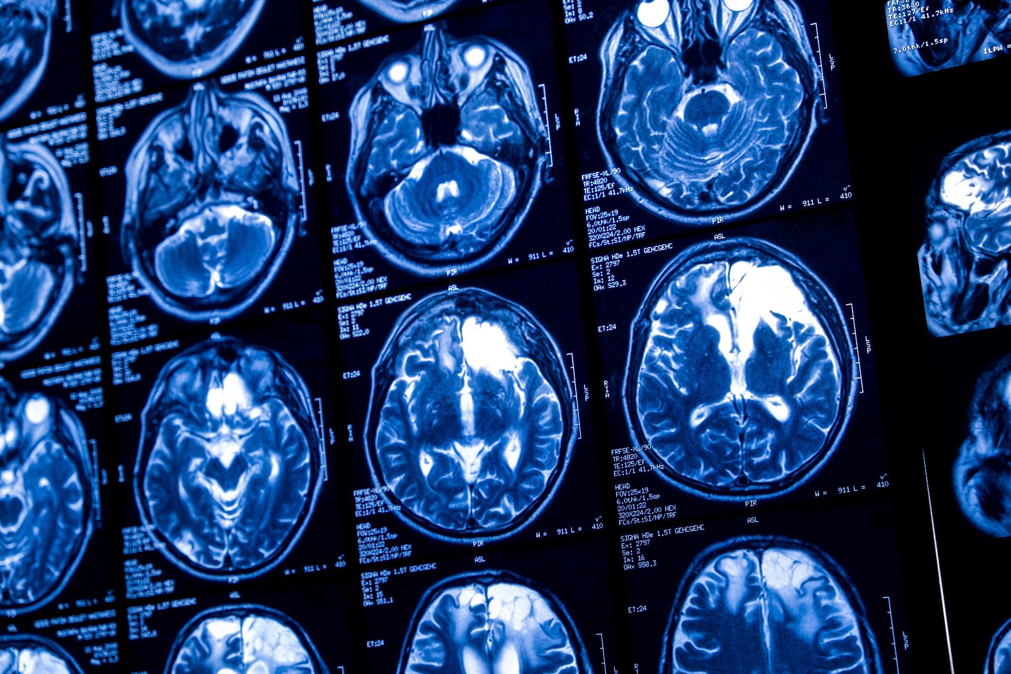 New Research Reveals Nanoplastics’ Damaging Effect on Brain Cells