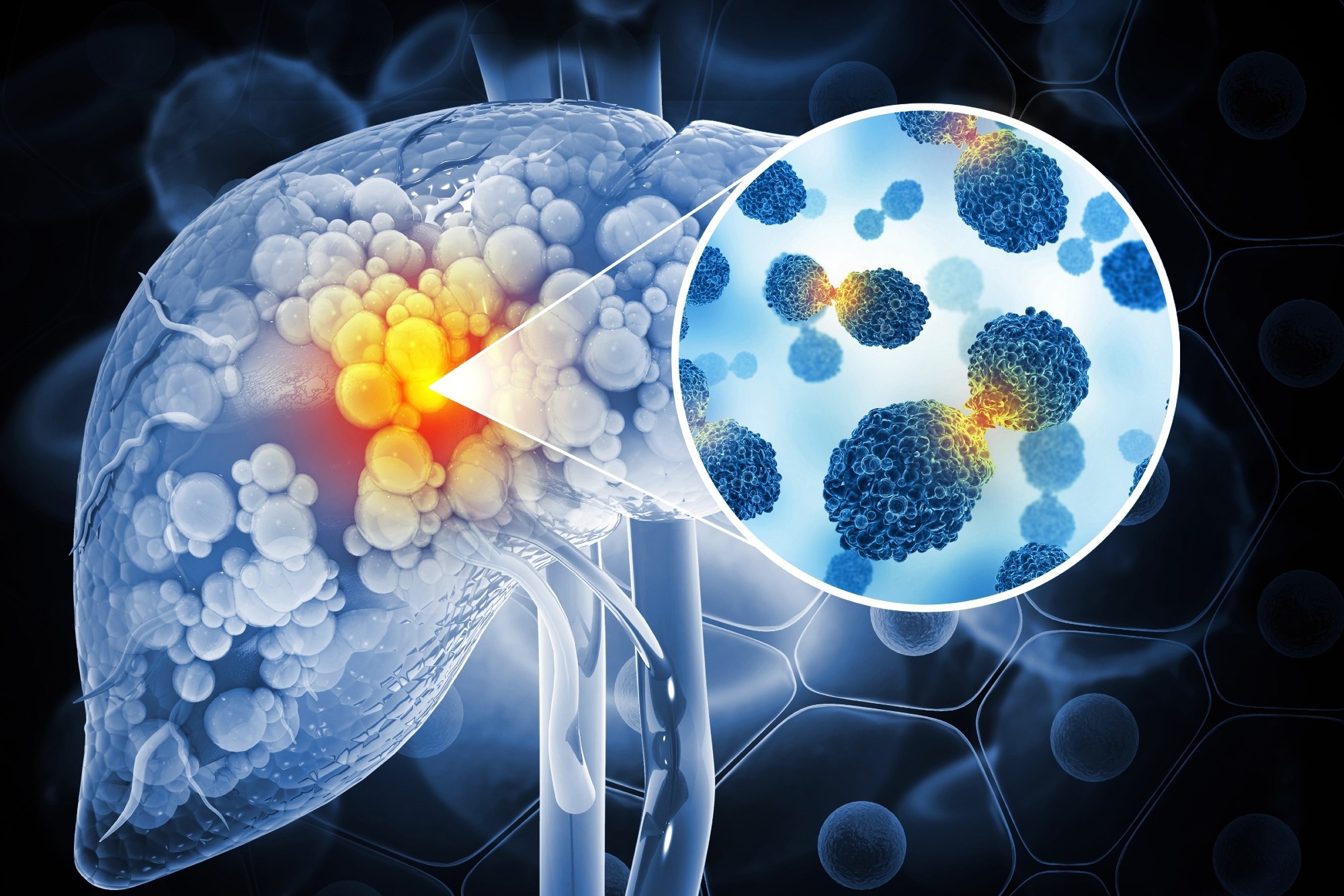 Liver cancer illustration with a overlay of the cancer cells upclose.