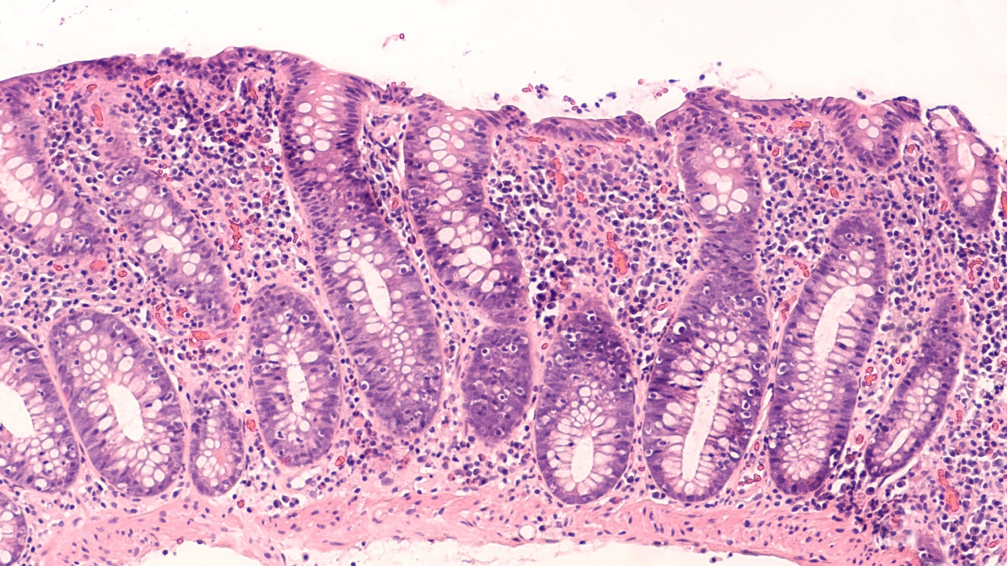 Photomicrograph of lymphocytic colitis, a type of microscopic colitis, showing increased numbers of intraepithelial lymphocytes
