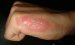 New Nano-Silver Skin Gel May Help Improve Treatment of Burns