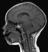 Nanoparticles "Seek and Destroy" Brain Cancer Cells