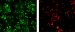 Carbon Nanotubes for Detection and Destruction of Breast Cancer