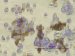 Using Magnetic Nanoparticles to Attach to Cancer Cells