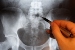 European Researchers Develop New Molecular Diagnostic Technology for Cervical Cancer