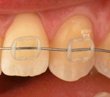 Nanoparticles Increase Mechanical, Friction Resistance in Dental Correction Orthodontics