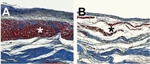 Injectable Hydrogel Helps Growth of New Heart Muscle Tissue