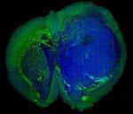 New Laser-Based SRS Microscopy May Improve Accuracy of Brain Tumor Surgery
