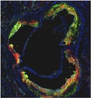 HDL Nanotherapy Targets and Lowers Dangerous Inflammation in Blood Vessels