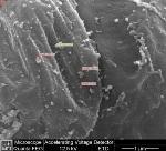 New Nanoscale Drug-Delivery System to Tackle Aggressive Ovarian Cancer