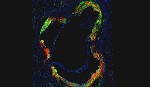 HDL Nanotherapy Directly Targets and Lowers Dangerous Inflammation in Blood Vessels