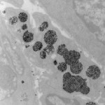 Magnetic Nanoparticle Hyperthermia May Hold Promise for Breast Cancer Treatment