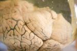 Levels of a Tiny Molecule May Provide Marker for Depression