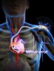 Flexible Piezoelectric Nanogenerator Operates Self-Powered Artificial Cardiac Pacemaker