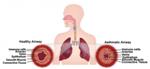 Human Airway Muscle-on-a-Chip May Help Test Drugs to Treat Asthma