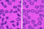 Tiny Microfluidic Device Helps Analyze Behavior of Blood from Sickle Cell Disease Patients