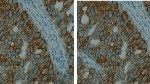 Proof of Concept ERC Funding to Help Develop Microfluidic Platform for Intra-Operative Tumor Immunohistochemistry
