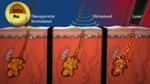 Nanotechnology and Transdermal Drug Delivery to Treat Acne