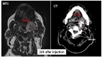 Positive Intermediate Results from Nanobiotix’s NBTXR3 Phase I/II Clinical Trial in Head and Neck Cancer
