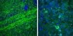 Laser-Based Stimulated Raman Scattering Microscopy Could Help Differentiate Between Tumor Tissue and Normal Brain